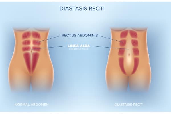 How Does Non-Surgical Treatment Help With Loose Skin, Weak Abdominal Muscles and Post-Pregnancy Changes Wallingford?