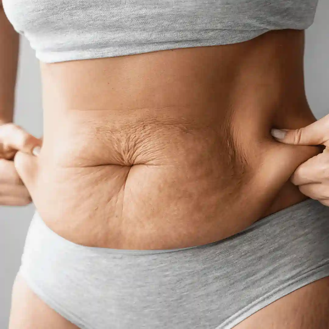 Is It Normal to Have Loose Skin After Pregnancy Wallingford?
