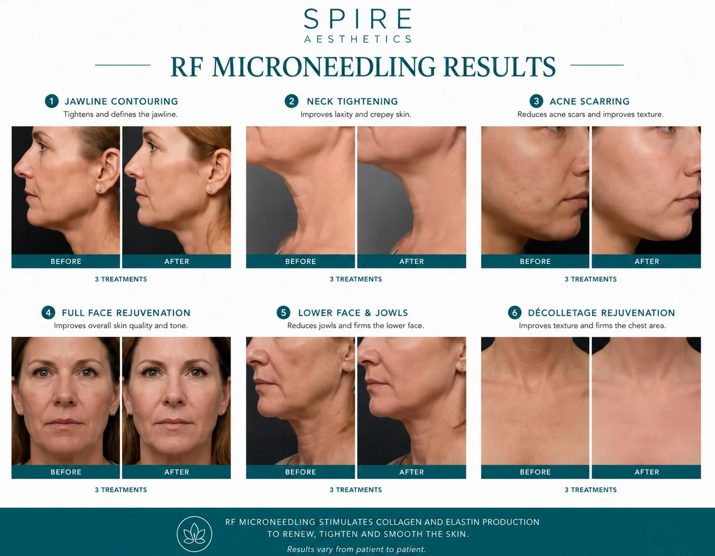 RF Microneedling Skin tightening Wallingford results