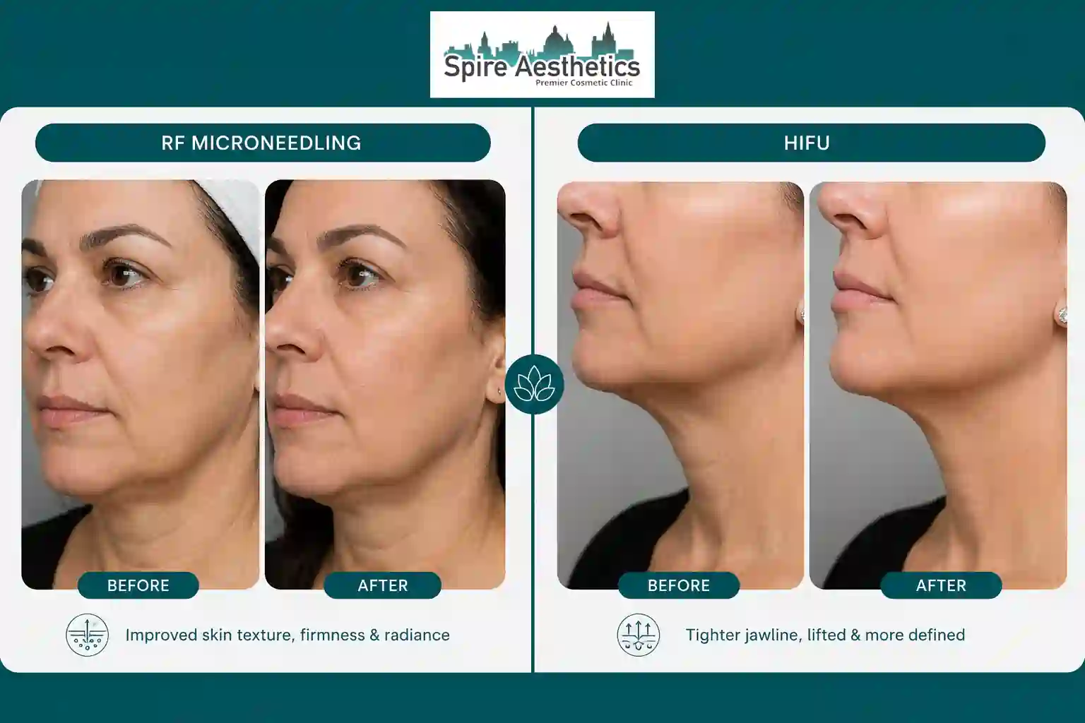 Can RF Microneedling and HIFU Be Combined Wallingford?