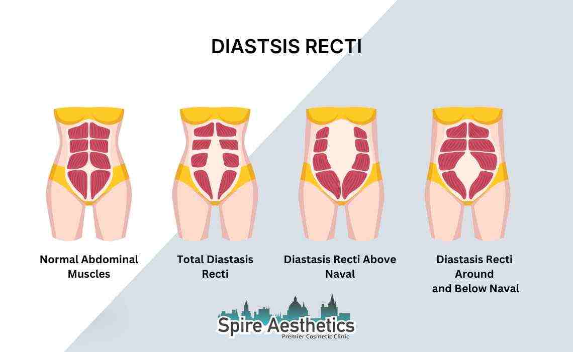 Is Non-Surgical Diastasis Recti Treatment Right for You? Common Concerns Answered Wallingford